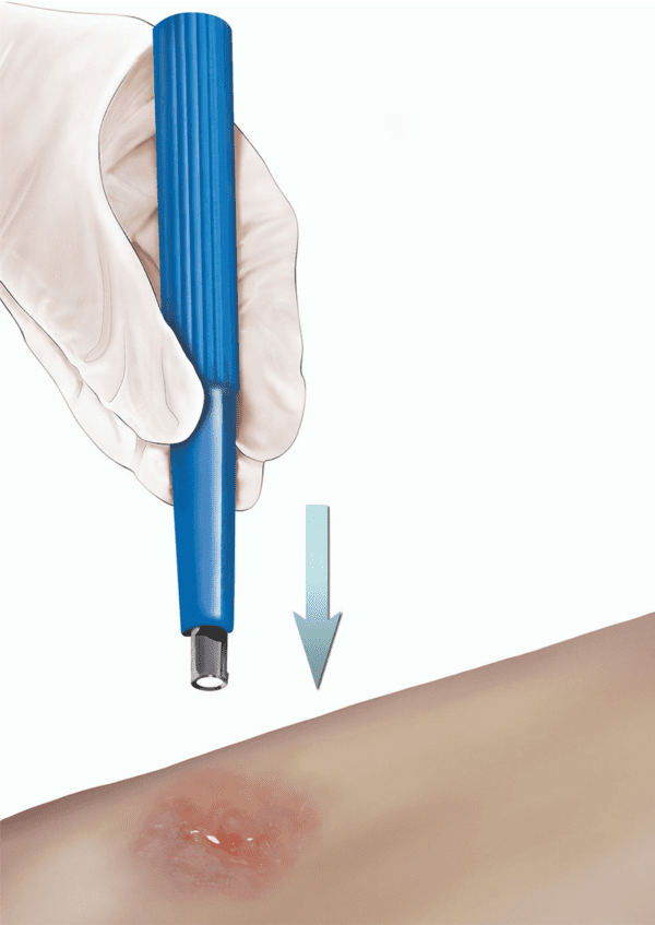 PUNCH BIOPSY